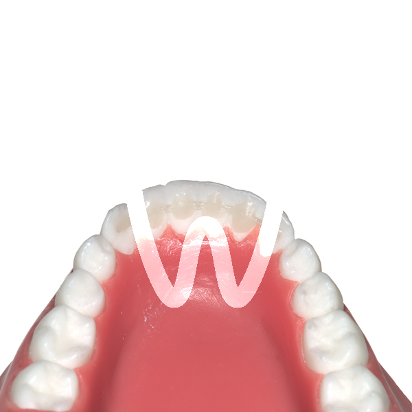 1 Pz Materiale Dentale Flessibile Striscia Di Fibra Di Vetro Stecca Strisce Di Fissazione Del Dente Sciolto Fotopolimerizzabile Incollaggio Apparecchi Di Contenzione Ortodontici